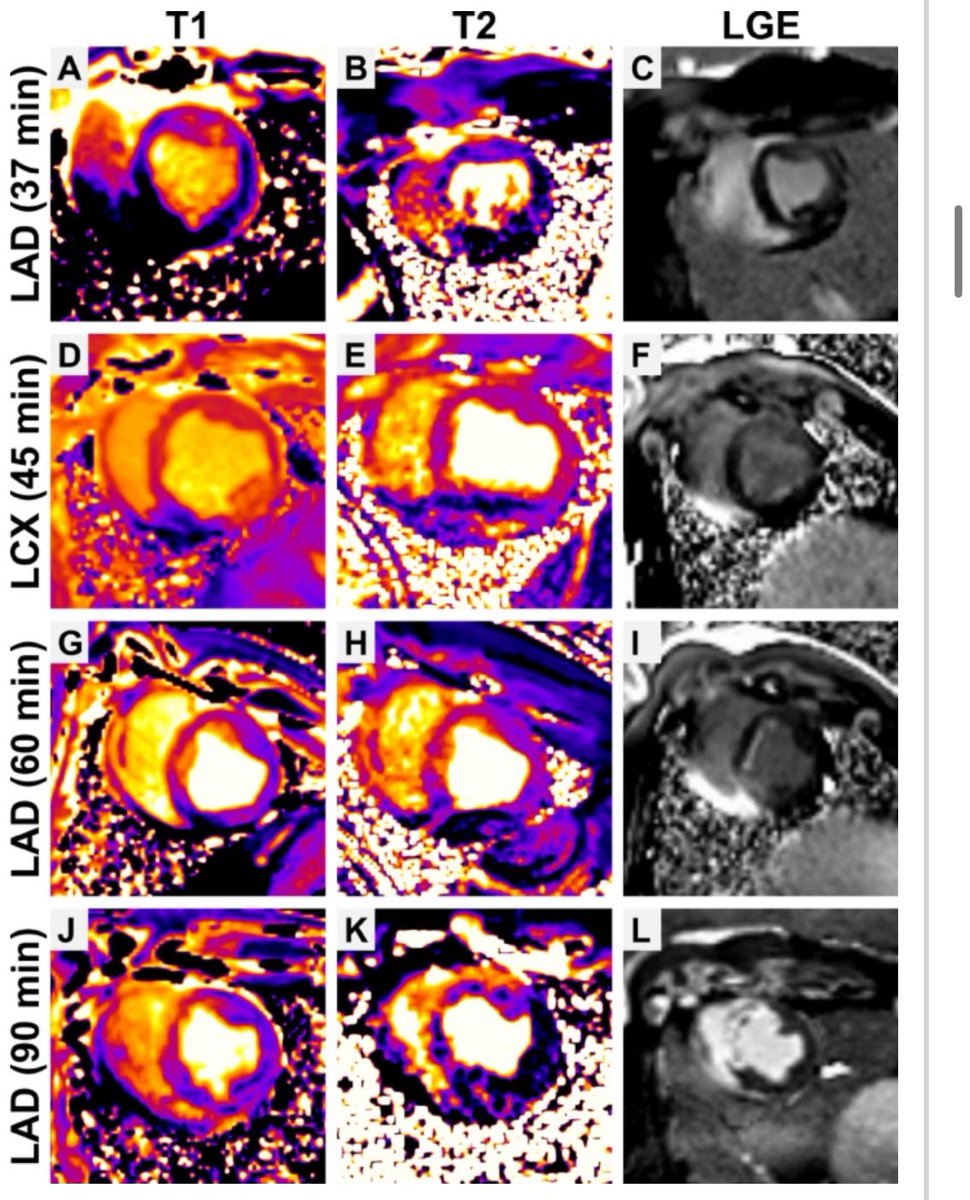 If you are doing 🐷 pig myocardial infarction studies ❤️‍🩹, David‘s MRI analysis will be interesting for you:

🚩MI indicated by LGE only occurred after ischemic durations ≥ 60 min

<a href="/DianaAleCJ/">Diana CJ-H</a> <a href="/LukasHegerMD/">Lukas Heger</a> <a href="/HeidtTimo/">TimoHeidt</a> <a href="/dirkwestermann/">Dirk Westermann</a> <a href="/UHZ_UNIFreiburg/">UHZ Freiburg - Bad Krozingen</a> 

rdcu.be/ew0Pa
