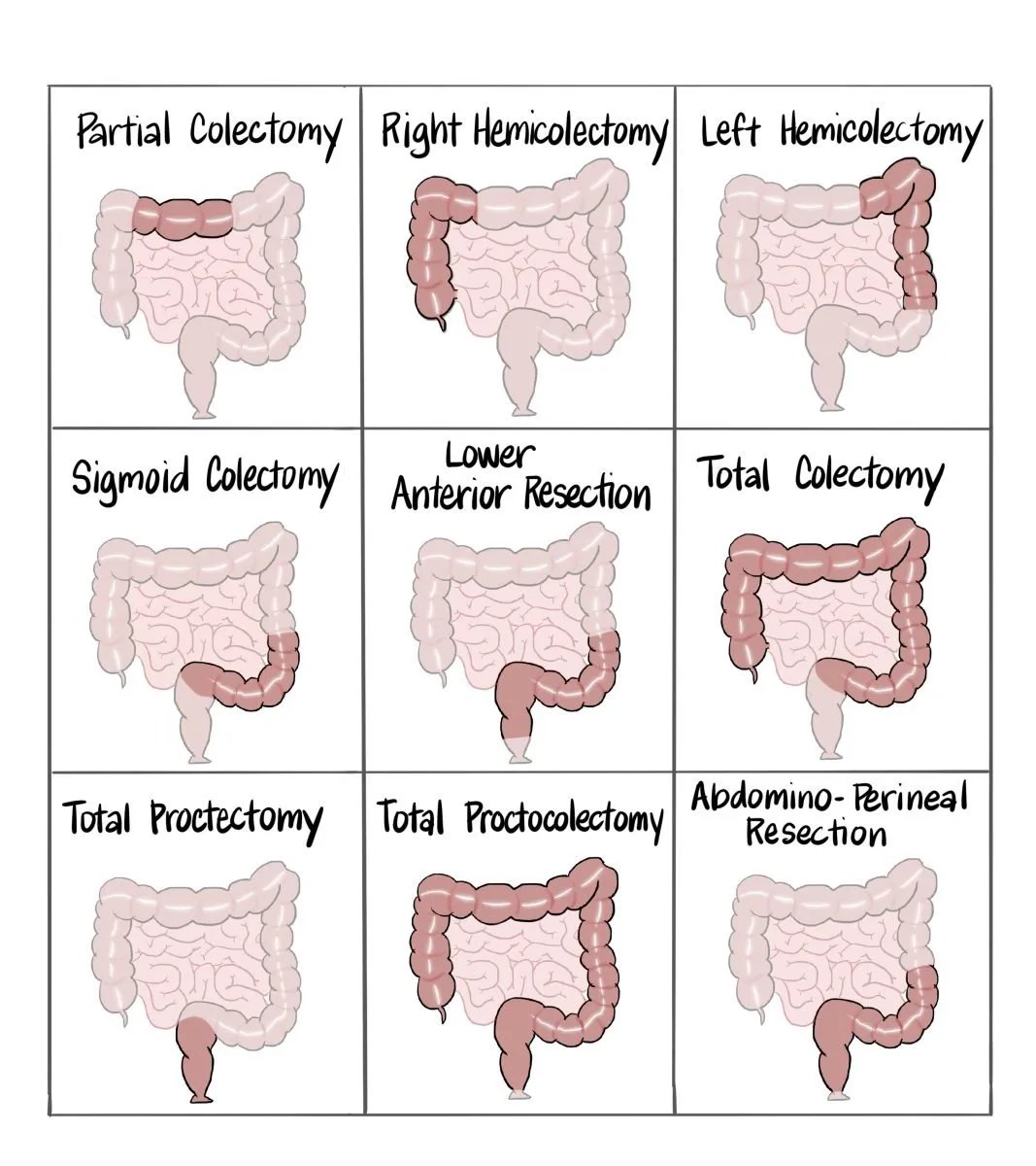 Early year PSAs #2 for #GI fellows:

🟢Use professional language to talk about colorectal surgeries (👇)

🟢🔑 differences = rectum gone (bottom 3) = ostomy.

🟢 Location of #IBD dictates surgical approach, understand this, and CRS will like you.