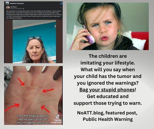 EMFRebel's tweet image. "5G radiation is blocked by the skin."
Even if this industry lie was true, it wouldn't stop 5G from giving you cancer. Radiation causes skin cancer, and skin cancer spreads through your entire body.
#5G #ParentingTips #FitnessTips #EHS #EV #HealthyLiving