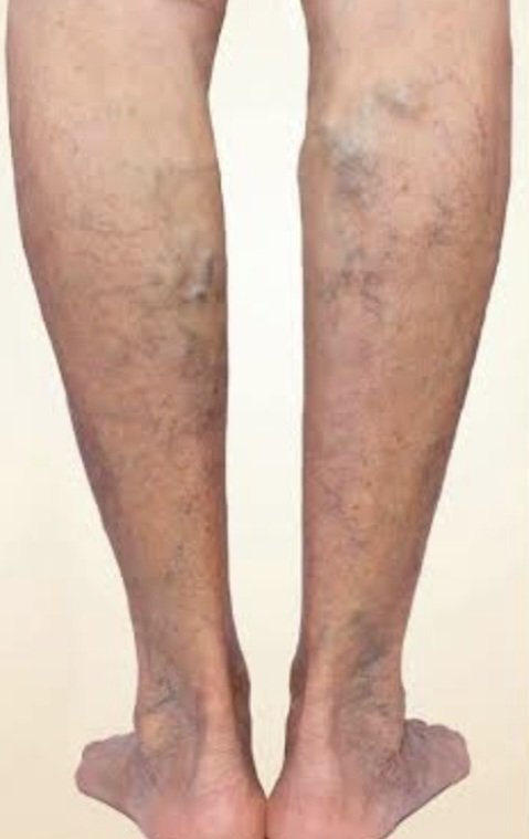Chronic venous insufficiency #CVI or #VaricoseVeins, is when leg veins struggle to pump blood back to the heart, causing swelling, aching, or heaviness. Damaged vein valves let blood pool, like a backed-up pipe. Early on, it’s uncomfortable but manageable with lifestyle changes