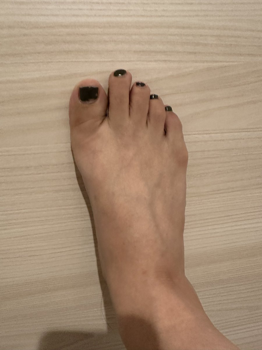 エスワンタイホウ
色素沈着経過観察20
2クール12日目
11日目は投稿忘れ

今日は外にいたから日焼けしたかも💦
あと２日と思うと少し元気になる

油っこいものばかり欲してしまう
ラーメン🍜や餃子🥟
#抗がん剤
#エスワンタイホウ　#色素沈着
#乳がん　#ルミナールb