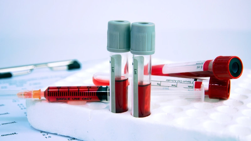 dogalyasalar's tweet photo. HEMOGRAM:

— HGB (Hemoglobin)
→ Oksijen taşıyan kırmızı kan pigmenti

Düşükse:
• Anemi
• B12, demir eksikliği
• Kronik hastalıklar
Yüksekse:
• Susuzluk
• Sigara
• Yüksek irtifa

 ✓ Ne yapmalı? Demir, B12, folat takviyesi; hidrasyon

— HCT (Hematokrit)
→ Kanda kırmızı hücre oranı

Düşük: Anemi, sıvı fazlalığı
Yüksek: Dehidrasyon, kalp/akciğer sorunları

 ✓ Bol su + beslenme takibi

— RBC (Eritrosit)
→ Alyuvar sayısı

Düşük: Demir, B12 eksikliği, iç kanama
Yüksek: Oksijen ihtiyacının artması (KOAH, sigara)

— MCV (Ortalama hücre hacmi)
→ Alyuvarların boyutu

Düşük (mikrositik): Demir eksikliği
Yüksek (makrositik): B12/folik asit eksikliği, alkol

— MCH – MCHC
→ Alyuvar başına düşen hemoglobin miktarı

Düşük: Demir eksikliği
Yüksek: Nadir genetik sorunlar

— RDW (Dağılım genişliği)
→ Alyuvarların çeşitliliği

Yüksek: Anemi başlangıcı, mikroskopik eksiklikler
Düşük: Homojen hücre boyutu = genelde iyi

— WBC (Lökositler)
→ Bağışıklık hücreleri

Yüksek: Enfeksiyon, inflamasyon, stres
Düşük: Bağışıklık düşüklüğü, kemik iliği baskılanması

 ✓ Uyku, stres azaltma, D vitamini + C vitamini

— NEU (Nötrofil)
→ Bakteriyel enfeksiyon savaşçısı

Yüksek: Enfeksiyon, iltihap, stres
Düşük: Virüs, bağışıklık yetmezliği

— LYM (Lenfosit)
→ Viral enfeksiyonla savaş

Yüksek: Viral enfeksiyon, EBV, otoimmün
Düşük: Bağışıklık baskılanması, ağır stres

— MON (Monosit)
→ Kalıntı temizliği, kronik inflamasyon

Yüksek: Enfeksiyon, otoimmün hastalık
Düşük: Nadiren anlamlı

—  EOS (Eozinofil)
→ Parazit, alerji, astım

Yüksek: Gıda alerjisi, SIBO, bağırsak problemi

 ✓ Şüpheli gıdaları kes, probiyotik destek

—  BAS (Bazofil)
→ Alerjik reaksiyonlarda aktif

Yüksek: Nadir, bazen hipersensitivite göstergesi

— PLT (Trombosit)
→ Pıhtılaşma hücreleri

Yüksek: İltihap, enfeksiyon
Düşük: Kanama riski, kemik iliği sorunu
