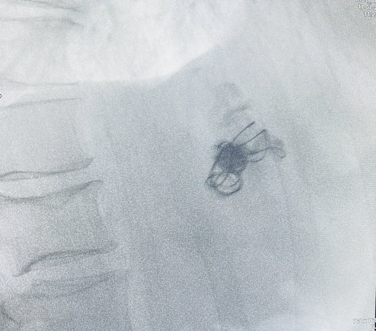 🔥LIVE ENDOHEPATOLOGY 🎯

🤏 EUS Liver Palpation 
🌊 EUS SWE (Liver &amp; Spleen)
🪡 EUS Liver Biopsy
🌀 EUS GV coiling &amp; glue injection
📈 EUS PPG

Skillfully delivered by <a href="/helpatologist/">Nadeem Tehami</a> <a href="/Marktheliverdoc/">Professor Mark Wright</a> #joecoad ⚓️ #MAES2025

🙏 Sajjad &amp; team Manchester for the opportunity!