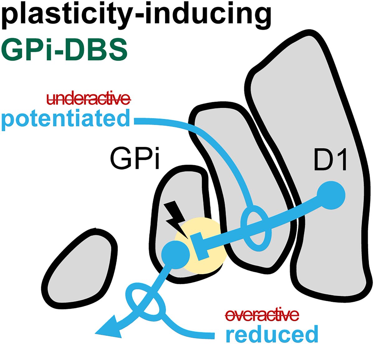 Brain1878's tweet image. Spencer et al. investigate the use of intracranial stimulation to improve movement in people with Parkinson's disease. They show that stimulating the globus pallidus internus improves motor function beyond the stimulation period. tinyurl.com/mrvf7tky