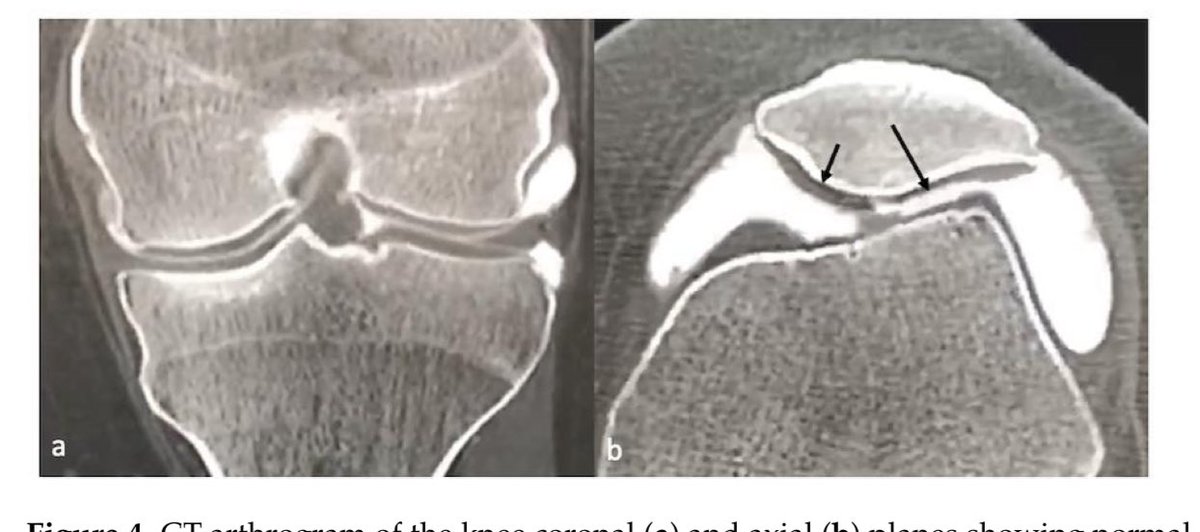 Imaging of Cartilage and Chondral Defects: An Overview
doi.org/10.3390/life13…

This review article provides an overview of cartilage and chondral defect imaging, emphasizing the role of different modalities in evaluating the health and integrity of articular cartilage. While