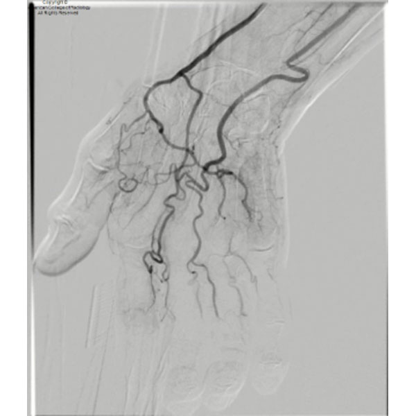 RadiologyACR's tweet image. A 60-year-old woman with a history of cirrhosis, hepatocellular carcinoma, and heavy smoking presents with a 2-month history of fingertip discoloration…#ACRCaseinPoint bit.ly/44Er7Ht