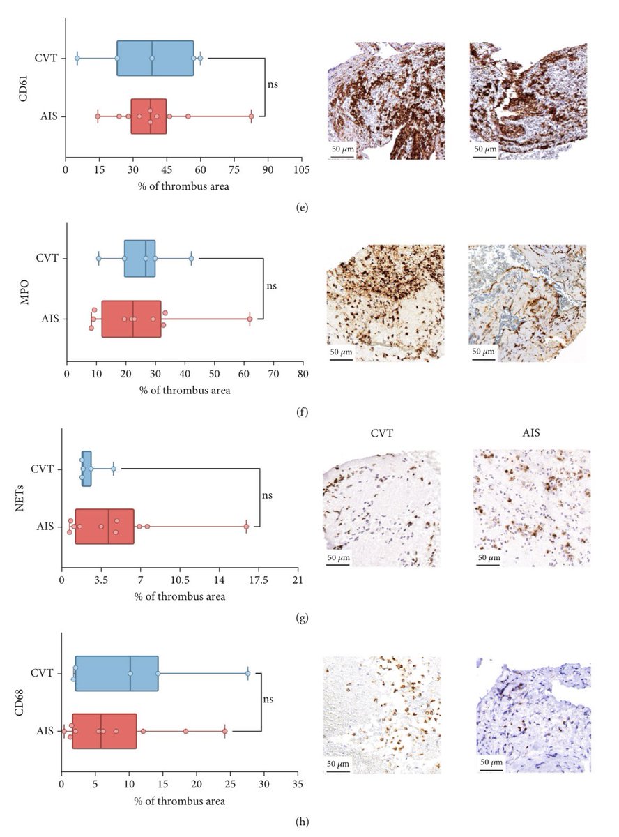 Ghil Schwarz (@ghilschwarz) on Twitter photo 🧠 New data on thrombus composition in CVT treated with mechanical thrombectomy🔬
Insights into CVT pathophysiology and need for international research effort.
<a href="/ShadiYaghi2/">Shadi Yaghi</a> <a href="/Diana_A_Sousa/">Diana Aguiar de Sousa</a> <a href="/NguyenThanhMD/">Thanh Nguyen 🇺🇦</a> <a href="/SvenPoli/">Sven Poli</a> <a href="/marcobacig/">marco</a>
🔗 pmc.ncbi.nlm.nih.gov/articles/PMC12… 🧠 New data on thrombus composition in CVT treated with mechanical thrombectomy🔬
Insights into CVT pathophysiology and need for international research effort.
<a href="/ShadiYaghi2/">Shadi Yaghi</a> <a href="/Diana_A_Sousa/">Diana Aguiar de Sousa</a> <a href="/NguyenThanhMD/">Thanh Nguyen 🇺🇦</a> <a href="/SvenPoli/">Sven Poli</a> <a href="/marcobacig/">marco</a>
🔗 pmc.ncbi.nlm.nih.gov/articles/PMC12…