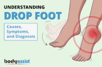 MSViewsandNews's tweet photo. Let's learn more about #FootDrop
https://t.co/xKtuJ2obXb
---------
#multiplesclerosis https://t.co/F0J3OfbGOM