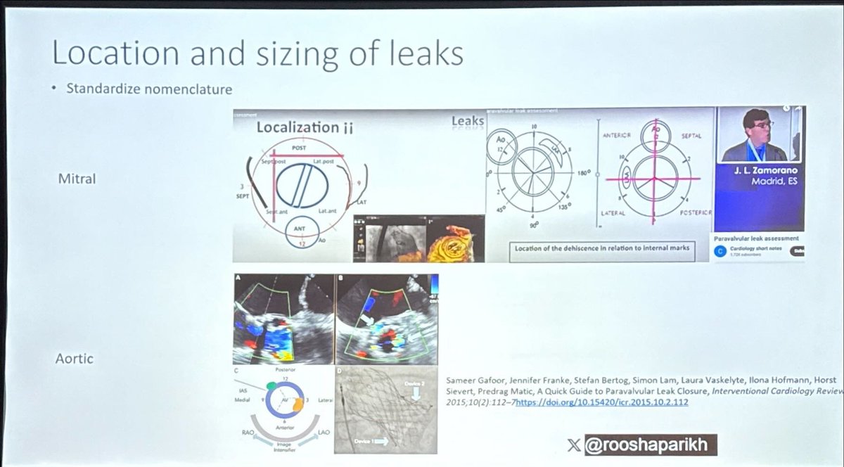 Localizing paravalvular leak! <a href="/Heart_SCCT/">Heart_SCCT</a> #SCCT2025 #YesCCT