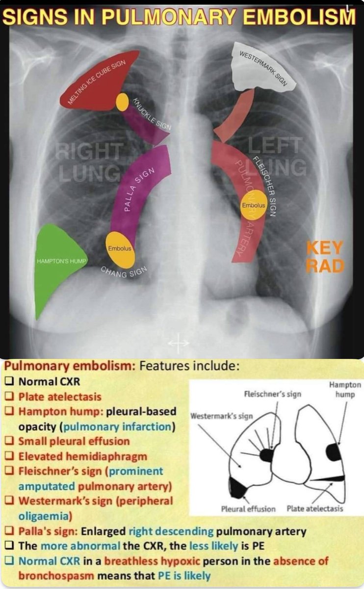 Pulmonary embolism chest x-ray signs