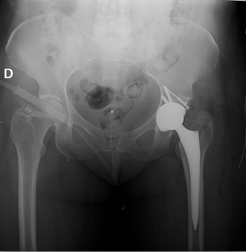 Secuelas enfermedad de Perthes, acetábulo displásico. Prótesis de cadera por vía anterior colocando injerto de su propia cabeza femoral en el techo para bajar el centro de rotación y compensar el acortamiento.