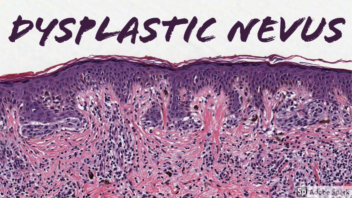 Jerad Gardner, MD (@jmgardnermd) on Twitter photo Dysplastic Nevus Explained in less than 5 Minutes. 
My (very) boiled-down take on a complex topic. 
Video: youtube.com/watch?v=Vgs1Gp…  
#dermpath #dermatology #dermatologia #dermtwitter #pathologists #pathology #pathTwitter Dysplastic Nevus Explained in less than 5 Minutes. 
My (very) boiled-down take on a complex topic. 
Video: youtube.com/watch?v=Vgs1Gp…  
#dermpath #dermatology #dermatologia #dermtwitter #pathologists #pathology #pathTwitter