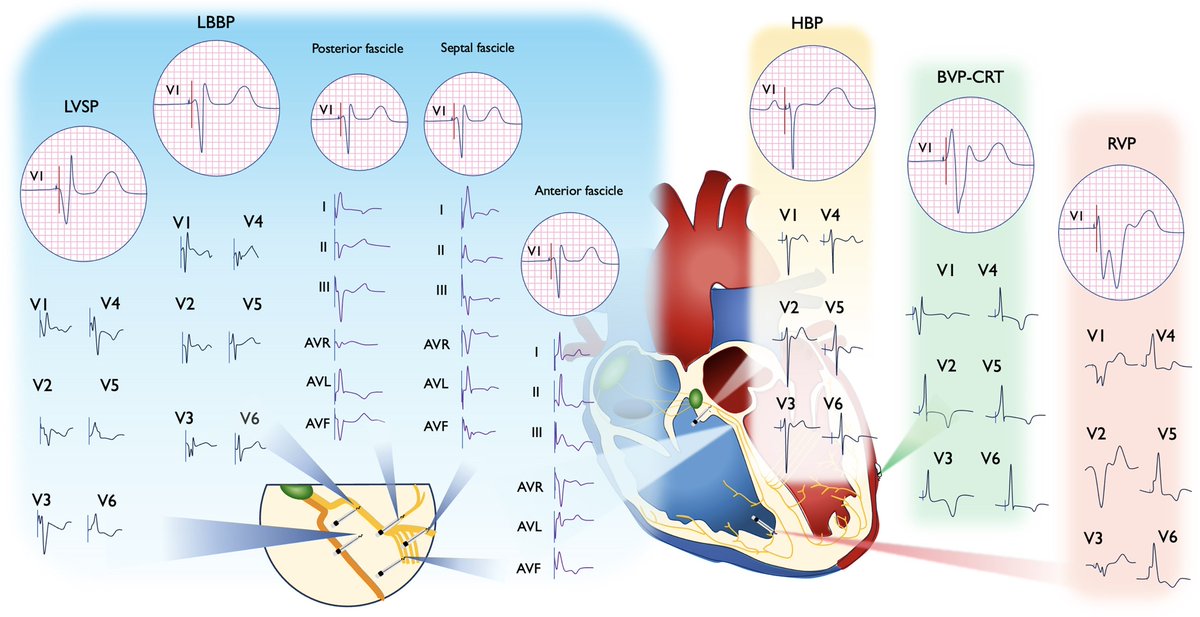 SeguraCardio's tweet image. 🫀 Physiological pacing (His bundle &amp;amp; LBB area) = more natural conduction, fewer complications, better outcomes.
📚 New #StateOfTheArt #Review explains why this is the future.

Follow for cutting-edge cardiology💡
#cardioEd #epeeps