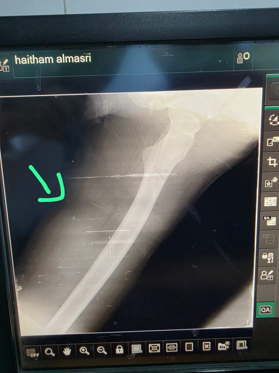 HaithamElmasri1's tweet image. Yesterday morning, warplanes targeted the shelter where my family and I live. Shrapnel flew everywhere, tearing through the space around us. I was injured in my leg, and my wife was wounded in her face. It was terrifyingโscreams mixed with the sound of destruction, and fearโฆ