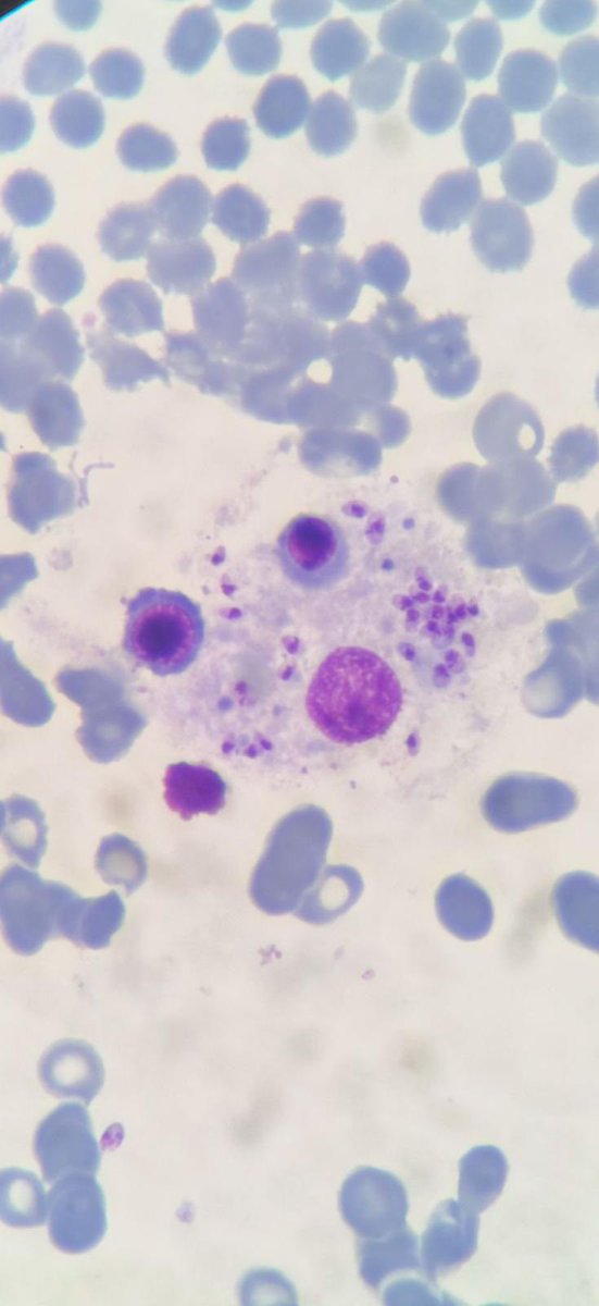 Went on a long trip, scrolling through old pics. This came up for my loved friends. A man with fever, weight loss and pancytopenia. Bone marrow showed this. What’s your diagnosis and next step?🤔