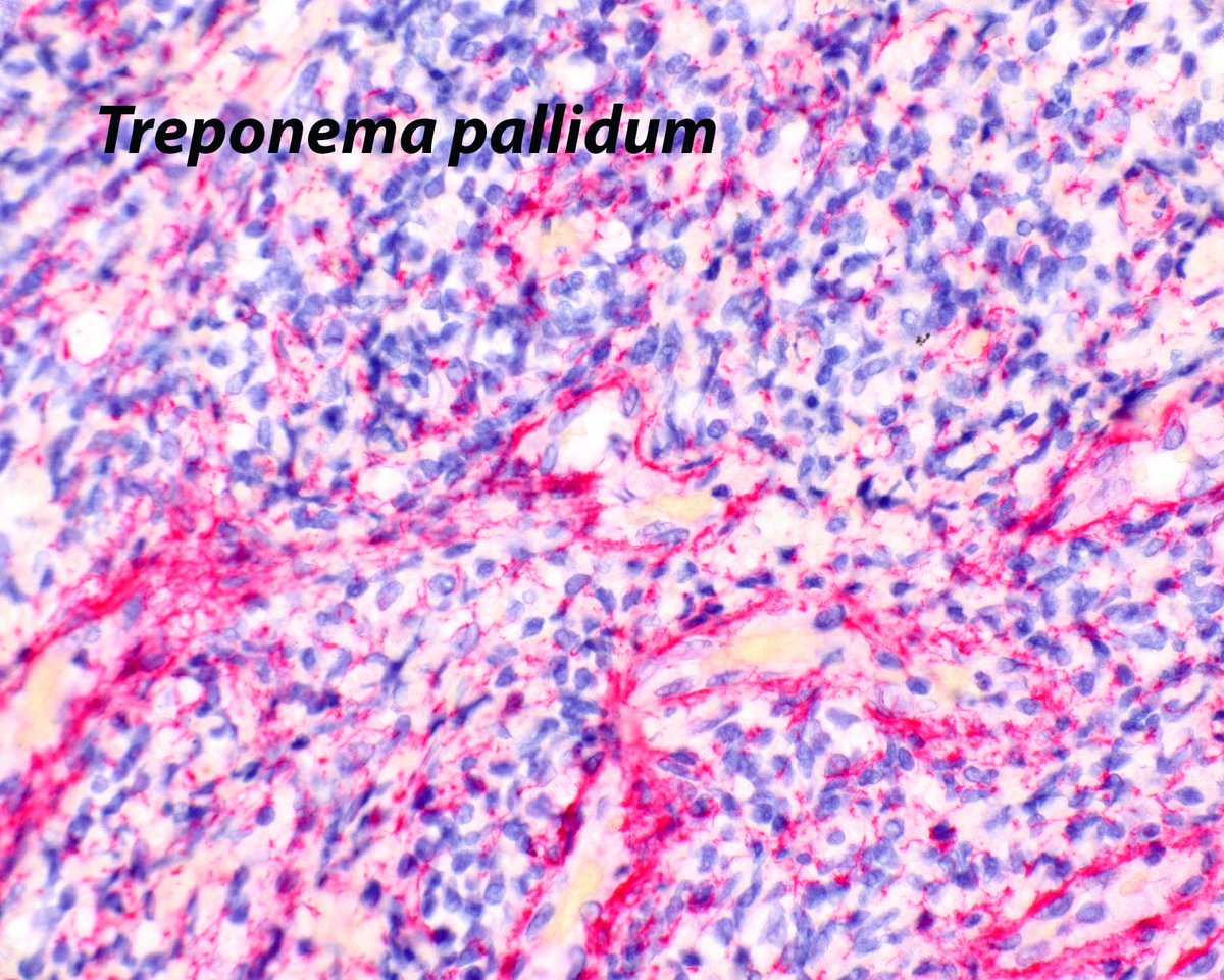 Here in the 305, we know syphilis proctitis. On immunostaining, It's is easier to interpret AEC (3-Amino-9-Ethylcarbazole); it produces red staining of the organisms. The brown DAB (3,3' Diaminobenzidine) staining in organisms appears similar to normal anal melanocytic processes.