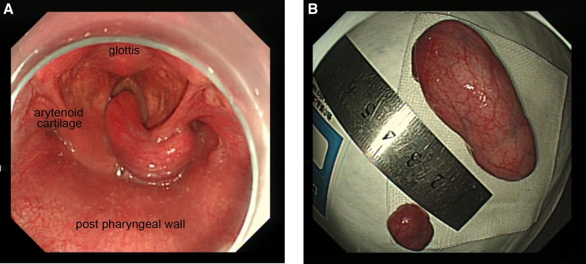 _Anesthesiology's tweet image. Revisit the March 2025 Images in #Anesthesiology - Do Not Miss the Critical Window during Esophagogastroduodenoscopy 📷 ow.ly/uEv850WqCrX