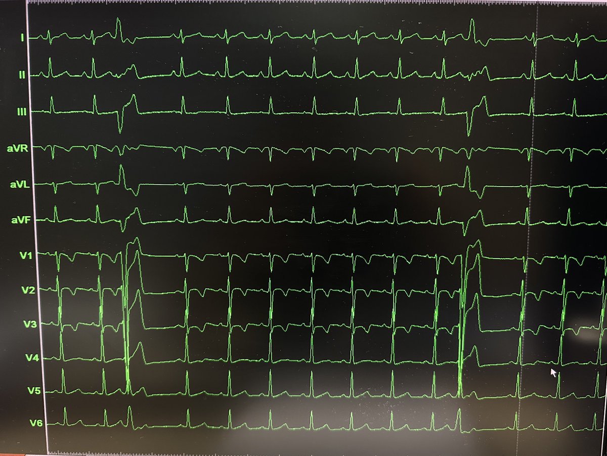 Where is this PVC’s focus ; after a few hrs. ablation was failed! 🤔#Epeeps