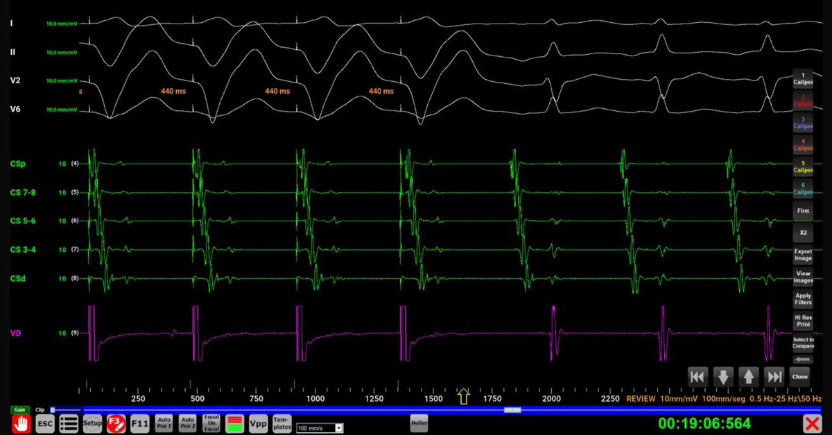 Another 30yo male patient with identical 12-ECG done last week.

Same diagnosis ?

There is a scale on the bottom to measure what you want.

#Epfellows