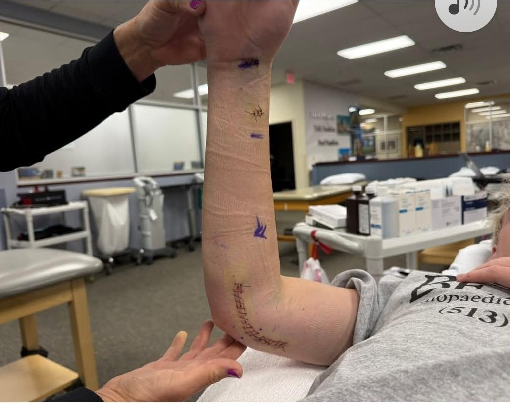 Carson Powell (@carson_powell2) on Twitter photo Surgery a success. Day 1 of Recovery and my way to the mound. Thank you, Doc Kremchek and everyone at Beacon!
<a href="/N_crab42/">Nolan Crabtree</a> <a href="/tgoodyrich/">Trey Goodrich</a> <a href="/JoshStraughan1/">Josh Straughan</a> @AlphaRecruitFL Surgery a success. Day 1 of Recovery and my way to the mound. Thank you, Doc Kremchek and everyone at Beacon!
<a href="/N_crab42/">Nolan Crabtree</a> <a href="/tgoodyrich/">Trey Goodrich</a> <a href="/JoshStraughan1/">Josh Straughan</a> @AlphaRecruitFL