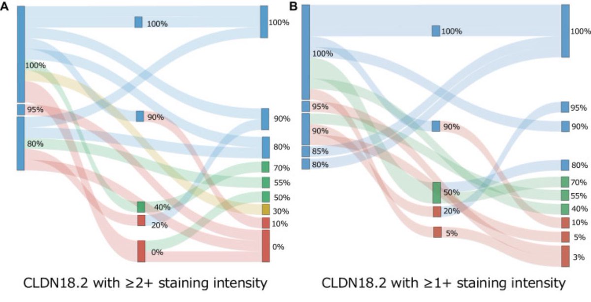 UGrewalMD's tweet image. Excellent study just out in ESMO GI Onc-

📊 Among 15 CLDN18.2⁺ gastric cancer pts treated w/ zolbetuximab:

🔹 53.3% lost CLDN18.2 ≥75% at progression
🔹 66.7% retained ≥40%
🔹 73.3% retained ≥25%

💡 Patients may still be eligible for next-gen CLDN18.2-targeted therapies…