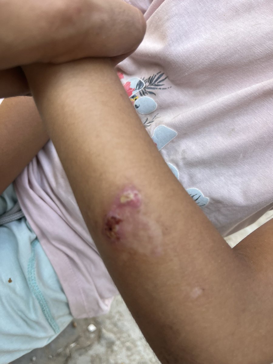 mogaza02's tweet image. The next looming crisis is the complete lack of basic hygiene supplies — soap, shampoo, and more.
We faced the same crisis last summer, & it led to widespread skin diseases among people.
These photos are from that time — when basic hygiene items disappeared from the markets💔