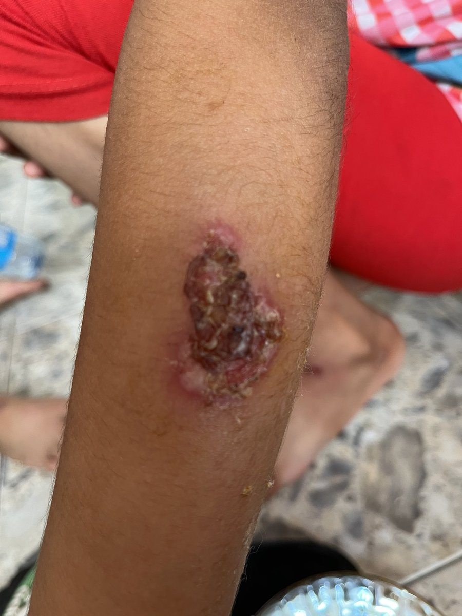 mogaza02's tweet image. The next looming crisis is the complete lack of basic hygiene supplies — soap, shampoo, and more.
We faced the same crisis last summer, & it led to widespread skin diseases among people.
These photos are from that time — when basic hygiene items disappeared from the markets💔
