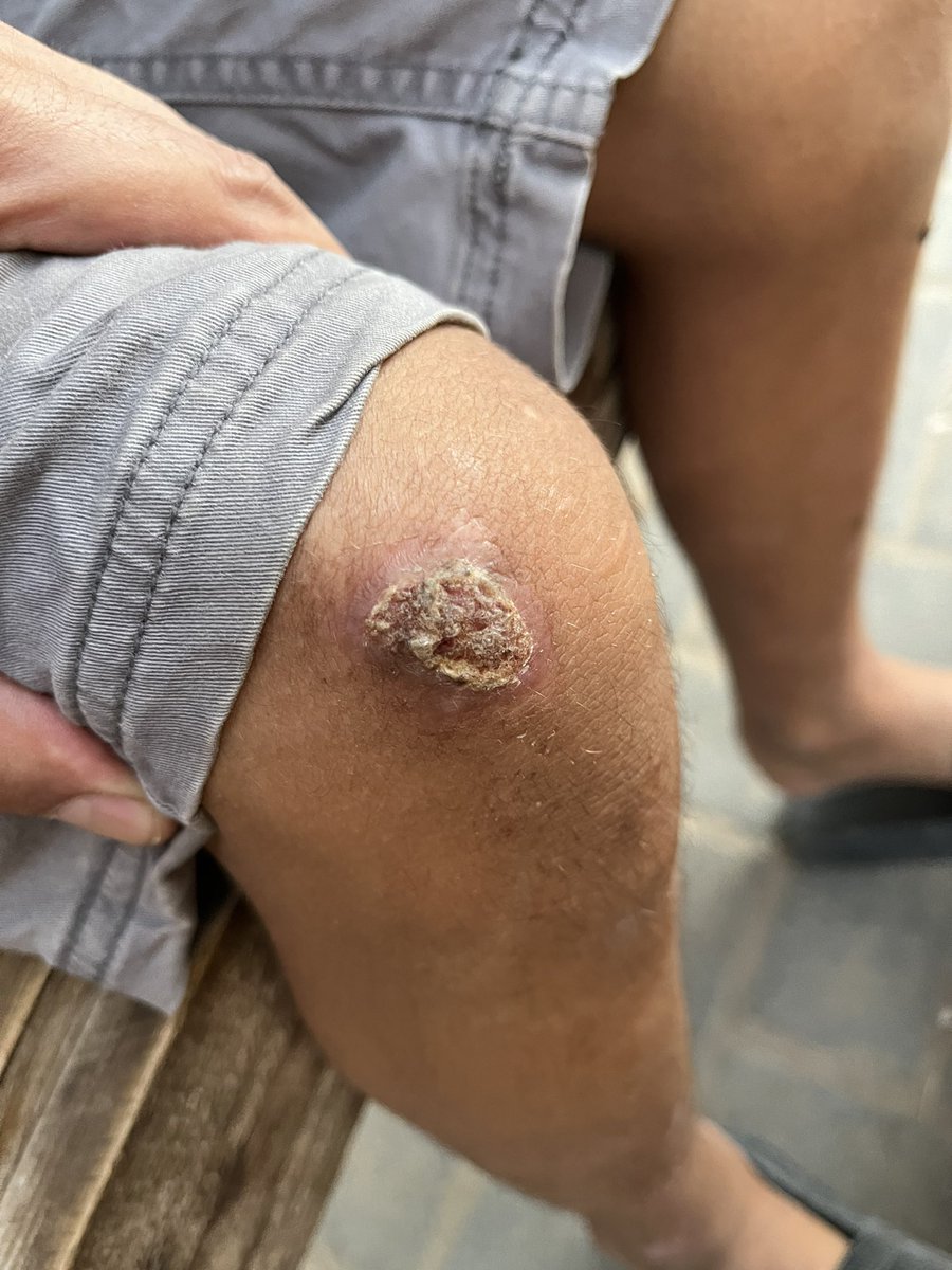 mogaza02's tweet image. The next looming crisis is the complete lack of basic hygiene supplies — soap, shampoo, and more.
We faced the same crisis last summer, & it led to widespread skin diseases among people.
These photos are from that time — when basic hygiene items disappeared from the markets💔