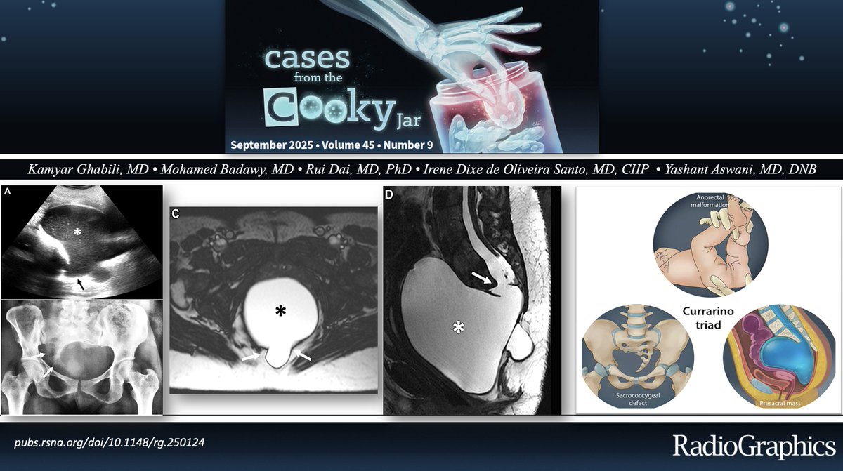 35F presents with pelvic fullness and abnormal pelvic exam 😕🩺
What is the diagnosis?

Answer: 🔗 pubs.rsna.org/doi/10.1148/rg…
Have a companion case? Share using #CookyBites #227. We will RT the best cases!

#RGphx <a href="/cookyscan1/">Cooky Menias</a> <a href="/RadioGraphics/">RadioGraphics</a>