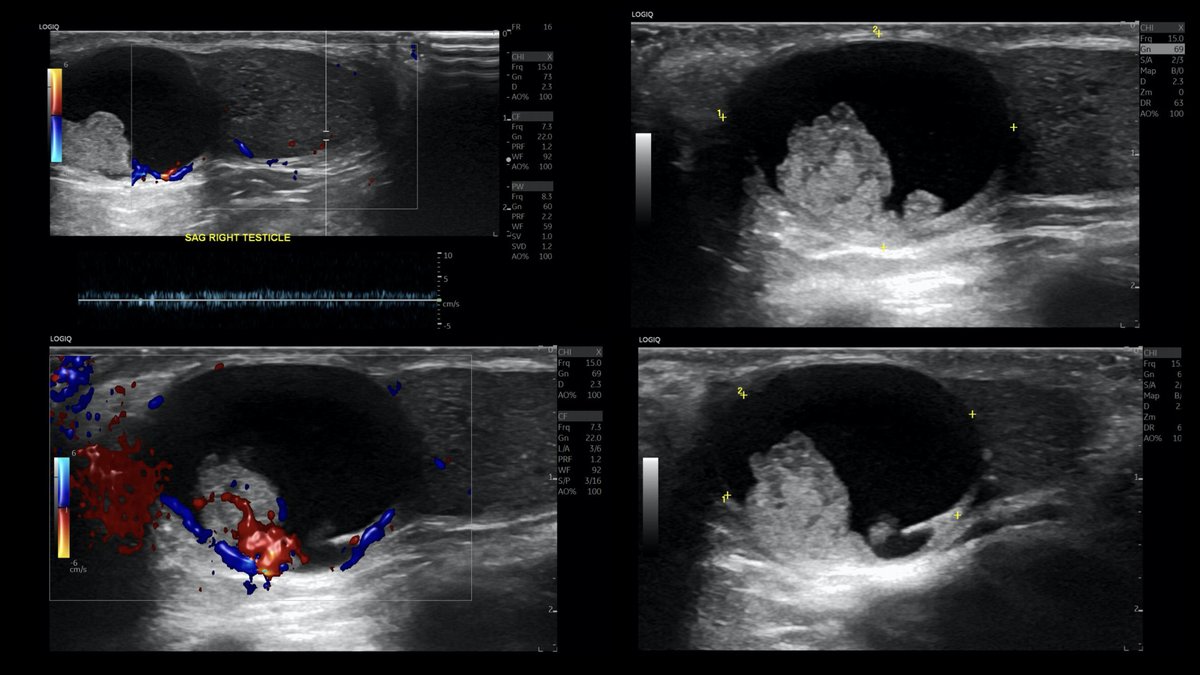 Daniel Souza (@danatsouza) on Twitter photo 25-year-old male patient presenting with abnormal scrotal ultrasound. Diagnosis? Next step?
<a href="/BrighamRad/">Brigham and Women's Radiology</a> <a href="/FOAMrad/">FOAMrad</a> <a href="/SAR_RFS/">SAR Resident and Fellow Section</a> <a href="/futureradres/">Future Radiology Residents</a> <a href="/ARRS_Radiology/">ARRS</a> <a href="/Abdominal_Rad/">Abdominal Radiology</a> <a href="/CBRadiologia/">CBR</a> #MedEd 25-year-old male patient presenting with abnormal scrotal ultrasound. Diagnosis? Next step?
<a href="/BrighamRad/">Brigham and Women's Radiology</a> <a href="/FOAMrad/">FOAMrad</a> <a href="/SAR_RFS/">SAR Resident and Fellow Section</a> <a href="/futureradres/">Future Radiology Residents</a> <a href="/ARRS_Radiology/">ARRS</a> <a href="/Abdominal_Rad/">Abdominal Radiology</a> <a href="/CBRadiologia/">CBR</a> #MedEd