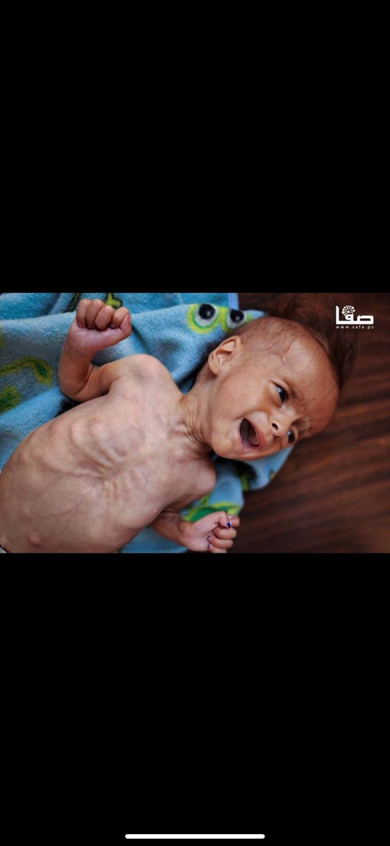 SpeakWithDeeDee's tweet image. ISRAEL IS STARVING BABIES‼️
Authorities in Gaza warned on 20 July that the strip is “on the brink of mass death” due to widespread famine and starvation resulting from Israel’s siege and genocidal war.
“We are on the brink of mass death due to the Israeli occupation's closure…