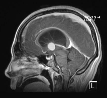 radRounds's tweet image. A 17-year-old presents with progressive headaches and blurry vision. MRI shows a midline, non-enhancing mass with hydrocephalus.
🧐 What’s the diagnosis?
A. Pineoblastoma
B. Colloid cyst
C. Germinoma
D. Ependymoma
👇Drop your guess & explain why!
#FOAMrad #Radiology #MedTwitter…