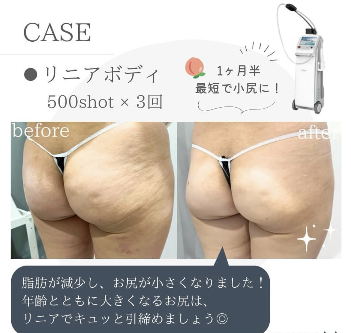新品未使用★ ボディリフト セルライト コントロール 1個 切らない痩身治療✨ リニアボディでは短期間で脂肪減少、セルライト