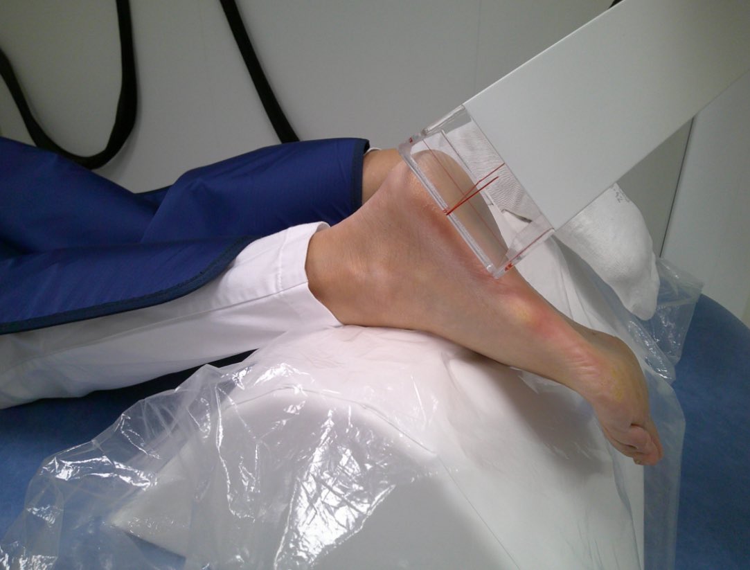 KoneruMd's tweet image. 🚨Proposed CMS Cuts to Orthovoltage Radiotherapy for Benign Conditions —A Threat to Patient Care and Specialty Sustainability
The newly proposed CMS rules would slash reimbursement for orthovoltage radiotherapy—used for benign conditions like osteoarthritis — by a nearly 40%…
