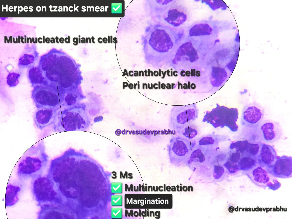 Herpes zoster on Tzanck smear prep ✅ 🔬 🦠
✅ Acantholytic cells: distinct Peri nuclear halo
✅ Multinucleated giant cells :3Ms: Multinucleation, Margination of chromatin and nuclear Moulding
#dermatopathology #dermatology #dermpath #pathology #pathX #PathTwitter #MedTwitter