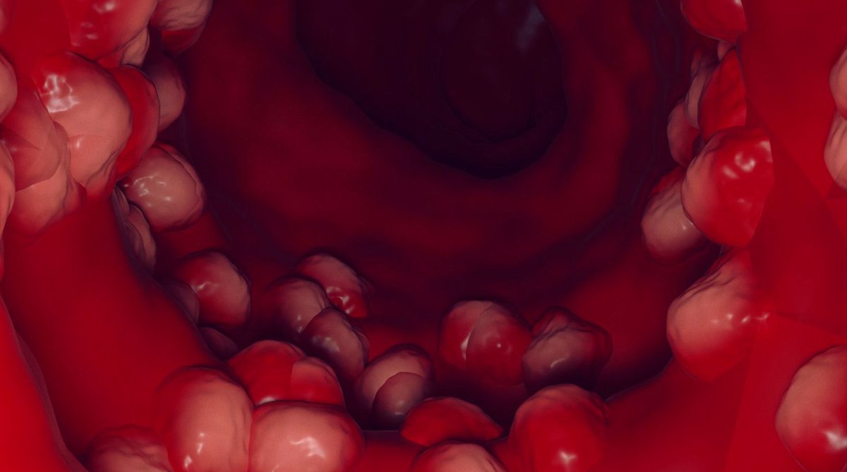 ScienceNews (@sciencenewsdk) on Twitter photo A new #study in Denmark shows that many people with newly diagnosed inflammatory bowel disease (#IBD) also have hidradenitis suppurativa (HS), a chronic skin #disease. A researcher says that rapid screening to determine whether people with inflammatory bowel disease have HS would A new #study in Denmark shows that many people with newly diagnosed inflammatory bowel disease (#IBD) also have hidradenitis suppurativa (HS), a chronic skin #disease. A researcher says that rapid screening to determine whether people with inflammatory bowel disease have HS would