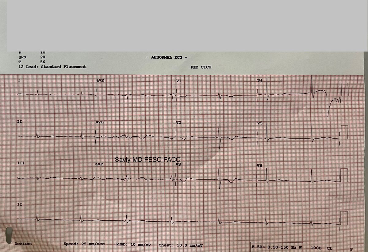 Oung Savly, MD,FACC,FASE,FESC,EACVI-CHD,FAPSC 🇰🇭 (@oungsavly) on Twitter photo 12-year-old child who received etoposide and carboplatin for brain tumor. <a href="/jeffrey_vinocur/">Jeffrey M Vinocur</a> <a href="/RobertHPass/">Robert H. Pass</a> <a href="/iamritu/">Ritu Thamman MD</a> <a href="/KaraMotonaga/">Kara Motonaga</a> 12-year-old child who received etoposide and carboplatin for brain tumor. <a href="/jeffrey_vinocur/">Jeffrey M Vinocur</a> <a href="/RobertHPass/">Robert H. Pass</a> <a href="/iamritu/">Ritu Thamman MD</a> <a href="/KaraMotonaga/">Kara Motonaga</a>