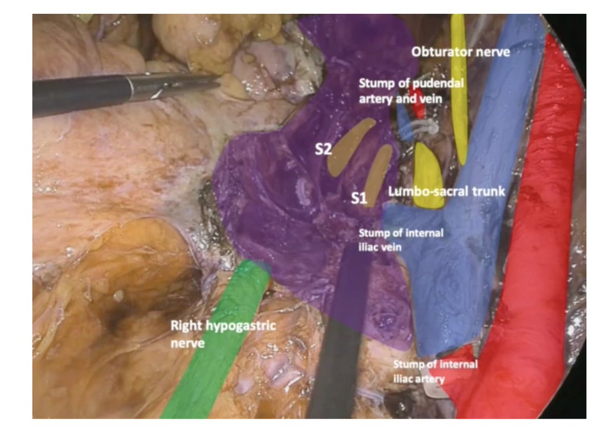 AnnSurgOncol's tweet image. July Issue: Laparoscopic Minimally Invasive Approach for Pelvic Solitary #FibrousTumor
rdcu.be/ewR8B
@DorianGarciaMD
@SyedAAhmad5