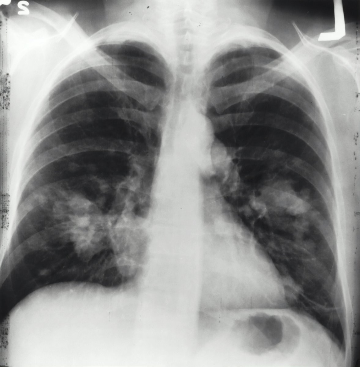 Big news in #CancerTreatment! 🎉Northwestern Medicine developed iSeg, an AI tool that precisely tracks lung tumors in 3D, even with patient breathing. It's catching hidden areas and now being tested for liver, brain, &amp; prostate cancers. 

➡️goo.su/dd4Hm

#Radiotherapy