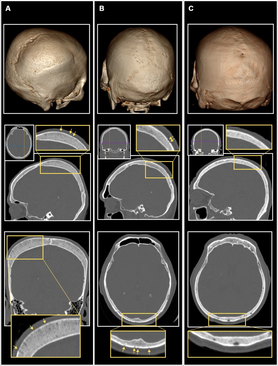 ScienceMagazine's tweet image. Porous cranial lesions in the skeletal remains of ancient forager–farmer communities are often hailed as markers for serious diseases such as infant-onset anemia.
New @ScienceAdvances findings suggest that these lesions correlate with compromised immune system activity.…