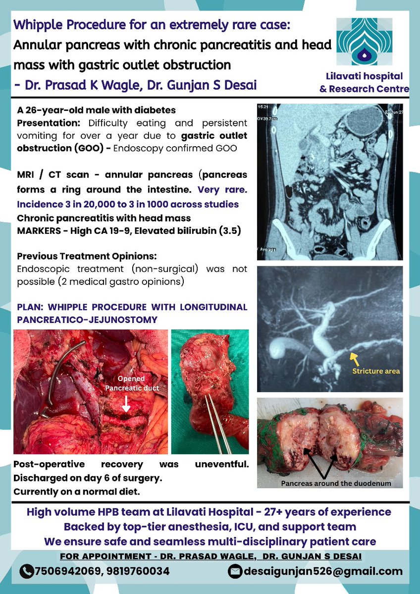 EduSurg Clinics (@edusurg_clinics) on Twitter photo 🔵 Whipple for a rare pancreatic ring!
26 y/o male with annular pancreas, chronic pancreatitis, head mass, GOO & jaundice.
Non-surgical options exhausted → complex Whipple + longitudinal PJ done ✅
Recovered well.
High-volume HPB care <a href="/LilavatiHRC/">Lilavati Hospital and Research Centre</a>.
<a href="/IHPBA/">IHPBA</a> <a href="/HPB_UGI_ACTREC/">HPB&UGI_ACTREC_TMC</a> 🔵 Whipple for a rare pancreatic ring!
26 y/o male with annular pancreas, chronic pancreatitis, head mass, GOO & jaundice.
Non-surgical options exhausted → complex Whipple + longitudinal PJ done ✅
Recovered well.
High-volume HPB care <a href="/LilavatiHRC/">Lilavati Hospital and Research Centre</a>.
<a href="/IHPBA/">IHPBA</a> <a href="/HPB_UGI_ACTREC/">HPB&UGI_ACTREC_TMC</a>