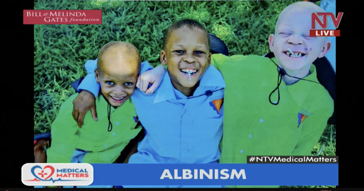 Albinism is a genetic condition causing reduced pigmentation. The most common type, oculocutaneous albinism (OCA), affects the skin, hair, and eyes. Ocular albinism (OA) mainly affects the eyes, with normal skin and hair color. Rare forms like Hermansky-Pudlak and Chediak-Higashi
