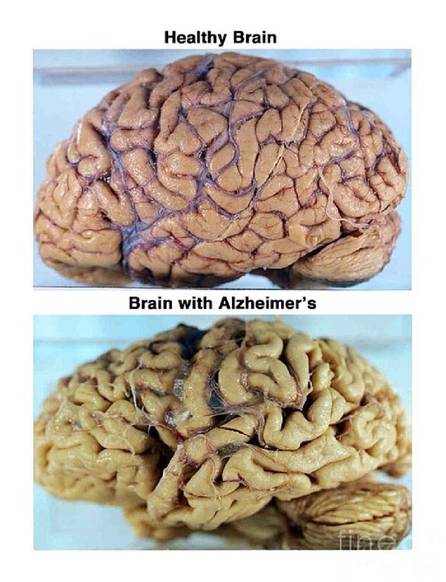 GreaseTheWheelz's tweet image. Everyone wants to build muscle…
But no one builds their brain.
You’ll notice it only when it starts to fail:
Brain fog. Anxiety. Mood swings.
Here’s how to heal and protect the organ that controls everything in your life 🧵