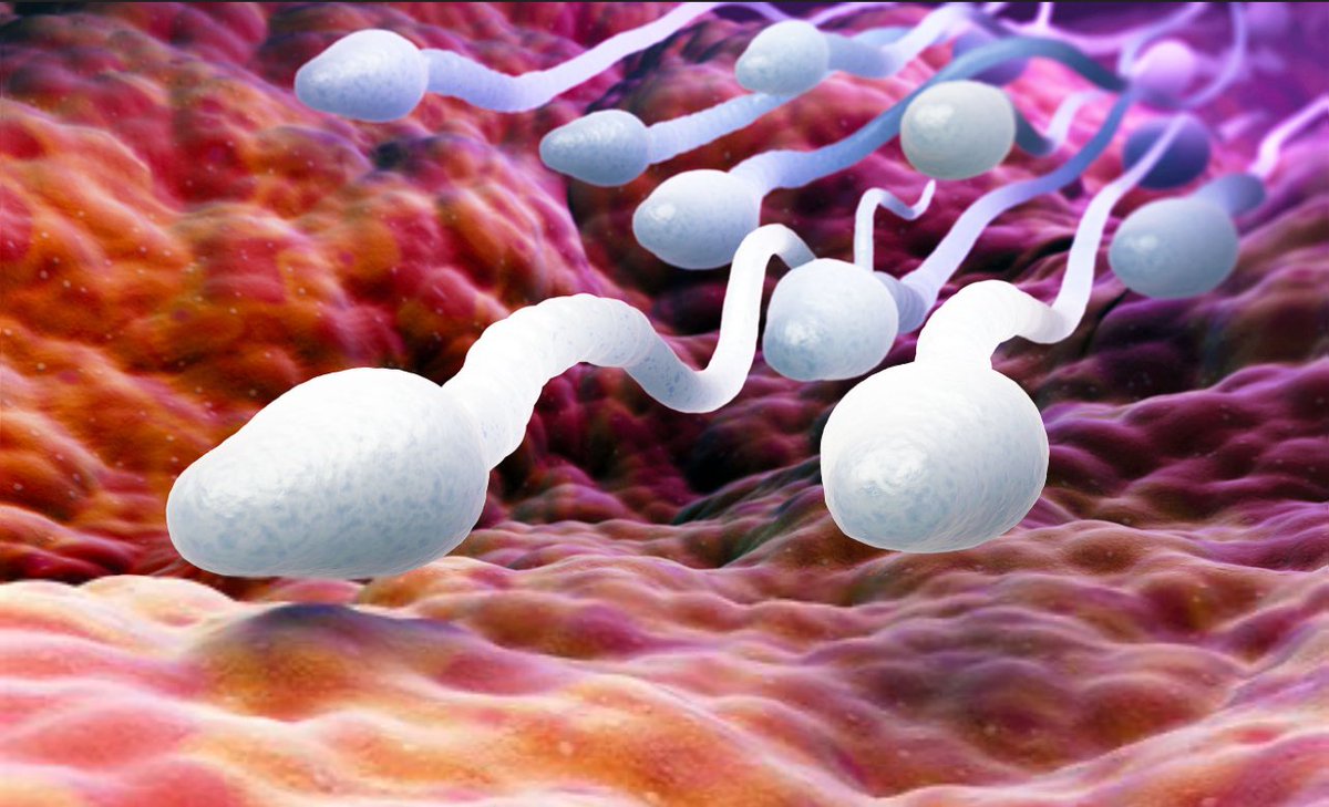 KateShemirani's tweet image. Sperm counts in Western men have dropped by over 52–60% since 1973, with average sperm concentration falling from 99 million/ml to 47 million/ml. Globally, men saw a 51.6% decline in concentration between 1973 and 2018, with the rate of decline doubling after 2000 to 2.64% per…