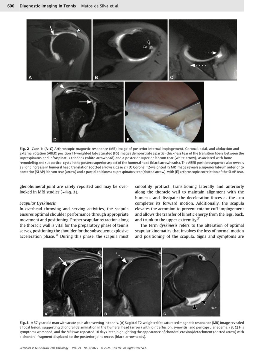 Julio B. Guimaraes, MD, PhD (@juliobguimaraes) on Twitter photo Happy to share our just published MS at Seminars in Musculoskeletal Radiology about Diagnostic Imaging in Tennis: Epidemiology, Biomechanics, and Radiologic Spectrum of Injuries!!! Many thanks <a href="/MarceloBordalo/">Marcelo Bordalo</a>!!! <a href="/fleury_online/">FleuryMedicinaeSaúde</a> <a href="/unifesp/">Unifesp</a> <a href="/UCSF/">UC San Francisco</a> Happy to share our just published MS at Seminars in Musculoskeletal Radiology about Diagnostic Imaging in Tennis: Epidemiology, Biomechanics, and Radiologic Spectrum of Injuries!!! Many thanks <a href="/MarceloBordalo/">Marcelo Bordalo</a>!!! <a href="/fleury_online/">FleuryMedicinaeSaúde</a> <a href="/unifesp/">Unifesp</a> <a href="/UCSF/">UC San Francisco</a>