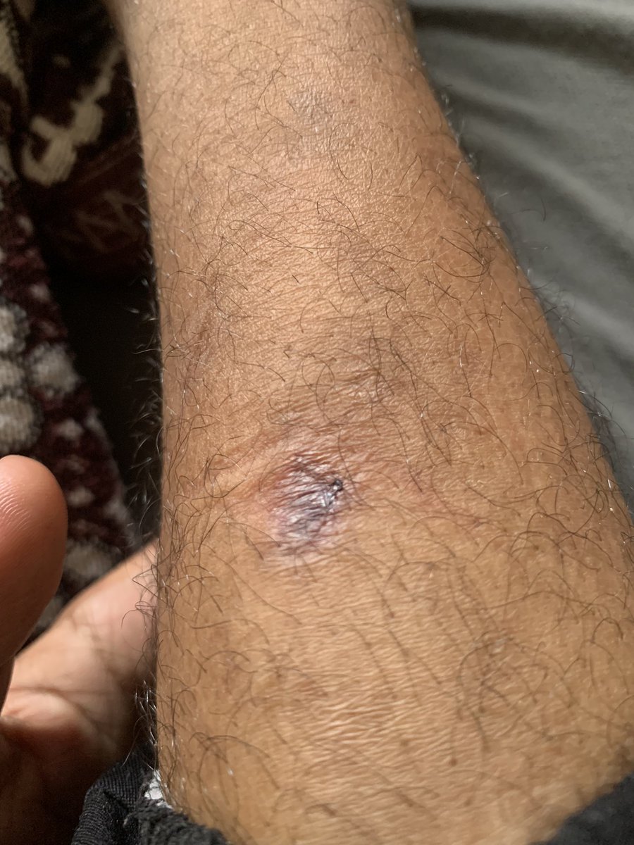 _alturky2001's tweet image. Hello everyone, I am writing to you with all the fatigue and exhaustion that has penetrated my depths.
I went last night to the Net Sreem axis area to get some flour, but they opened the gates of hell on us.
I was injured by some small shrapnel that resulted from the bullets…