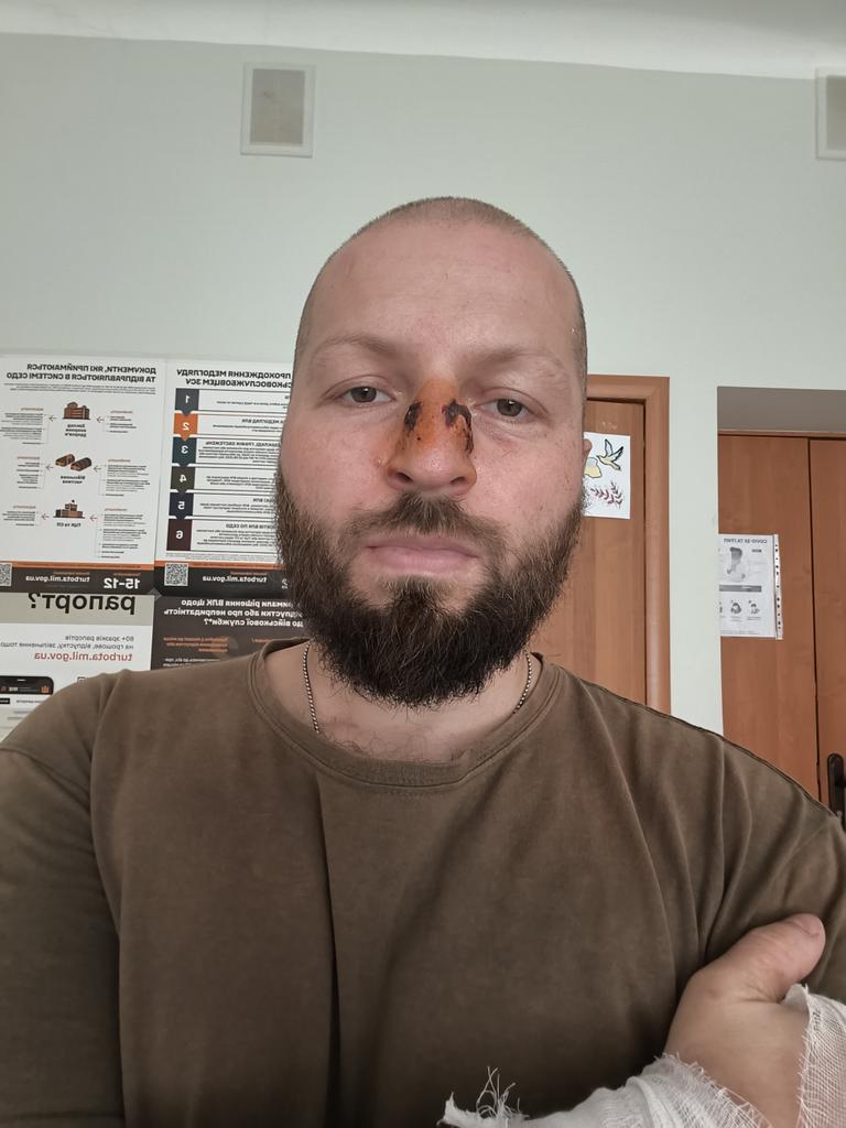 TseyYenotKusaye's tweet image. Хто робить військовим безкоштовно відновлювальну пластику? Вогнепальний перелам кісток носа, уламки в гайморовій пазусі. Тут, де я, операцію, схоже, робити не будуть