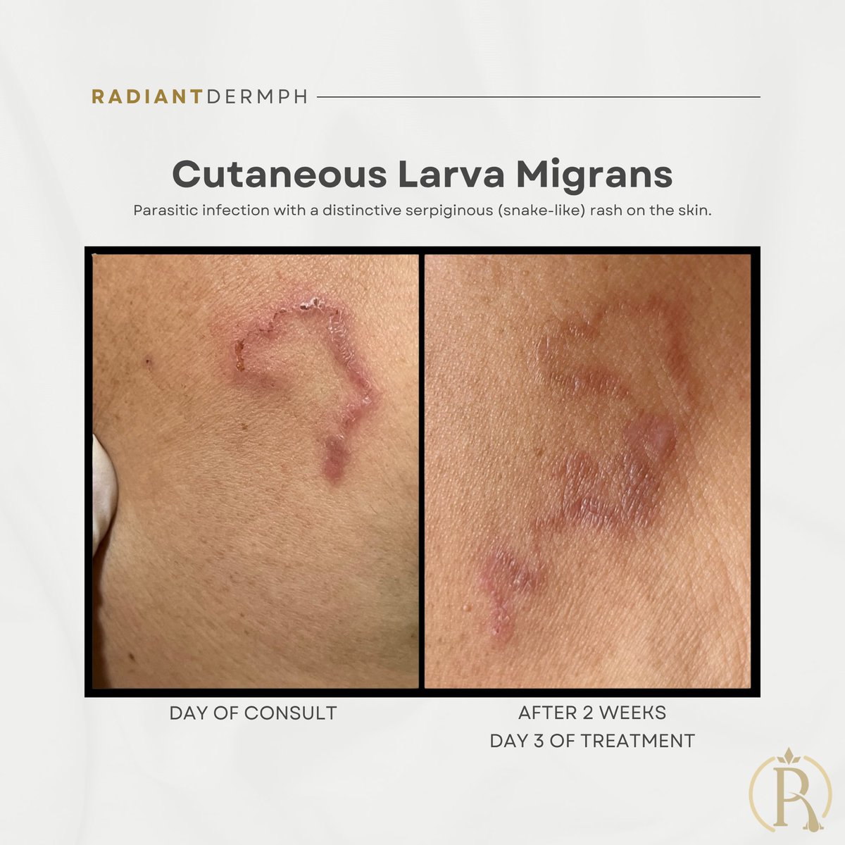 R-jay F. Agbon (@rjayagbonmd) on Twitter photo ๐๐๐: ๐๐ก๐ ๐๐ซ๐๐๐ฉ๐ข๐ง๐ ๐๐๐ฌ๐ก
Ever seen a rash like this? This distinctive serpiginous (snake-like) pattern is characteristic of ๐๐๐๐ฎ๐ป๐ฒ๐ผ๐๐ ๐๐ฎ๐ฟ๐๐ฎ ๐ ๐ถ๐ด๐ฟ๐ฎ๐ป๐ (๐๐๐ ), a parasitic infection. ๐๐๐: ๐๐ก๐ ๐๐ซ๐๐๐ฉ๐ข๐ง๐ ๐๐๐ฌ๐ก
Ever seen a rash like this? This distinctive serpiginous (snake-like) pattern is characteristic of ๐๐๐๐ฎ๐ป๐ฒ๐ผ๐๐ ๐๐ฎ๐ฟ๐๐ฎ ๐ ๐ถ๐ด๐ฟ๐ฎ๐ป๐ (๐๐๐ ), a parasitic infection.