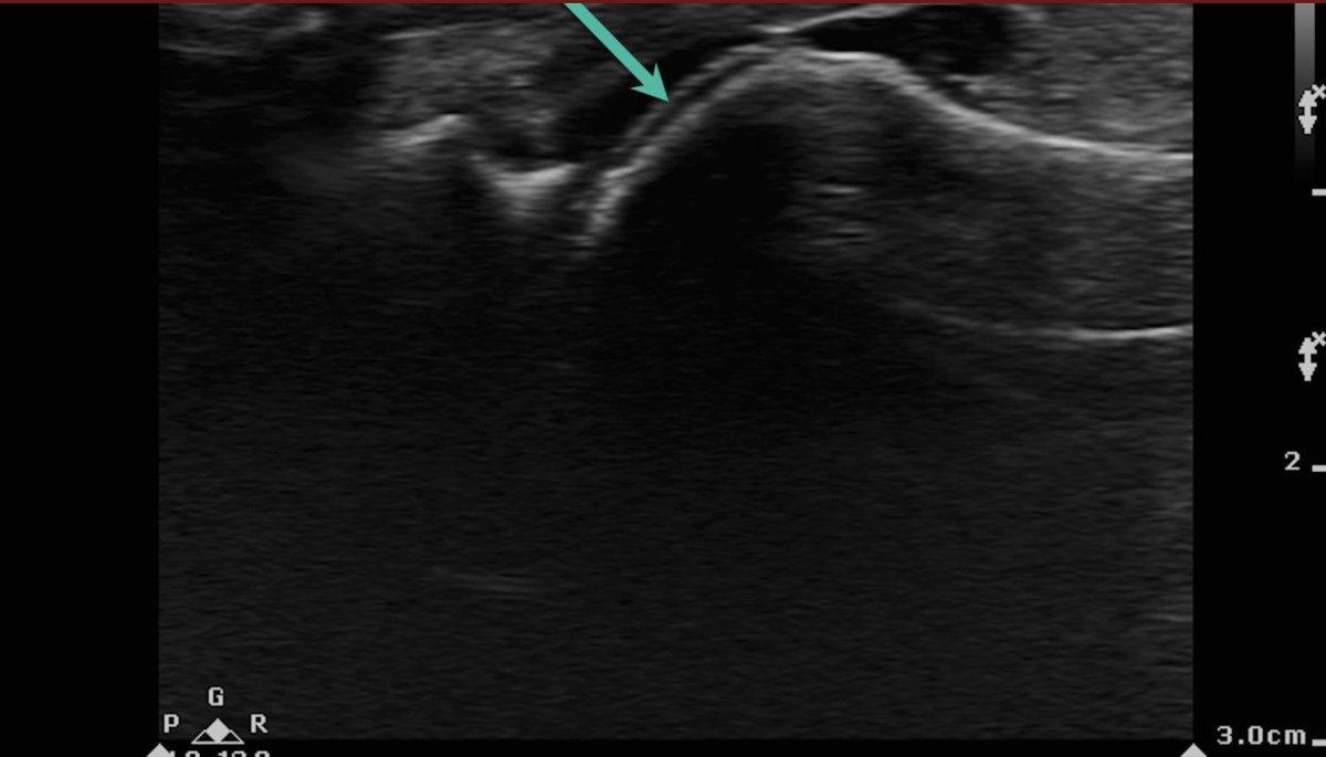 What sonographic finding on the SAG scan of the MTP joint is identified by the green arrow?

ANSWER: Note the presence of an echogenic line on the superficial margin of the anechoic hyaline cartilage. This is referred to as the “double contour sign” and is a specific finding for