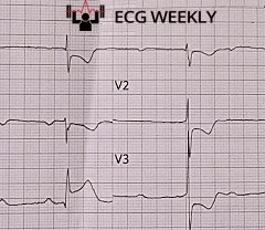 A 68-year-old woman calls EMS after having a syncopal episode while using the bathroom. She reports associated chest pain over the past day. The following prehospital ECG is obtained:ecgweekly.com/weekly-workout…